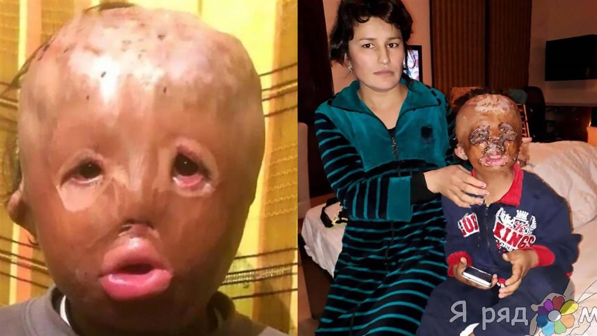 臉龐遭火吞噬!5歲男童天真許下聖誕心願…惹淚崩