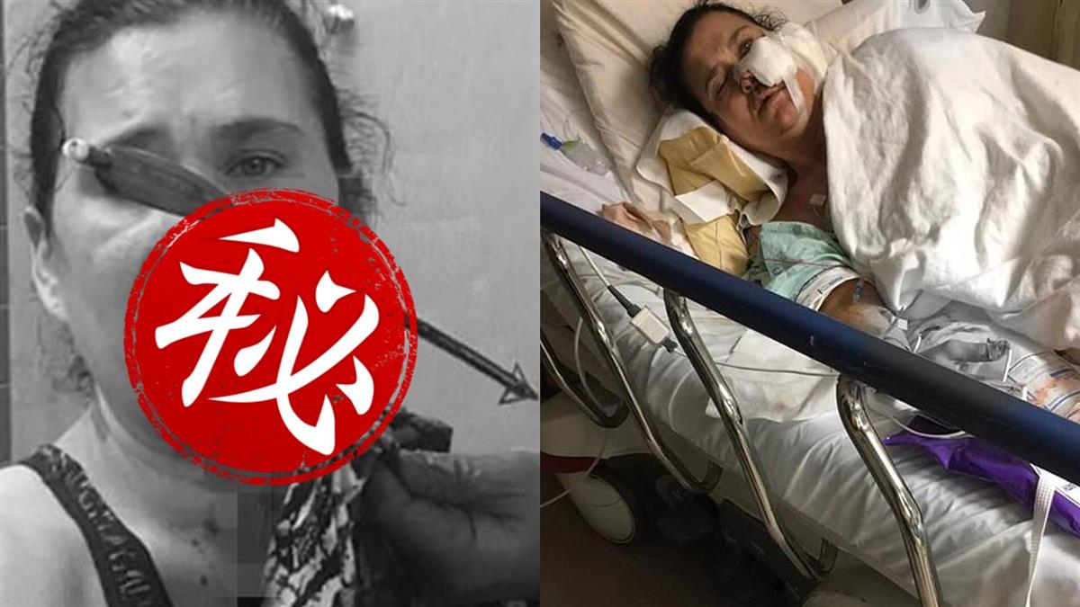 勇母護子慘遭十字弓射穿臉!驚悚插箭就醫…幾近毀容