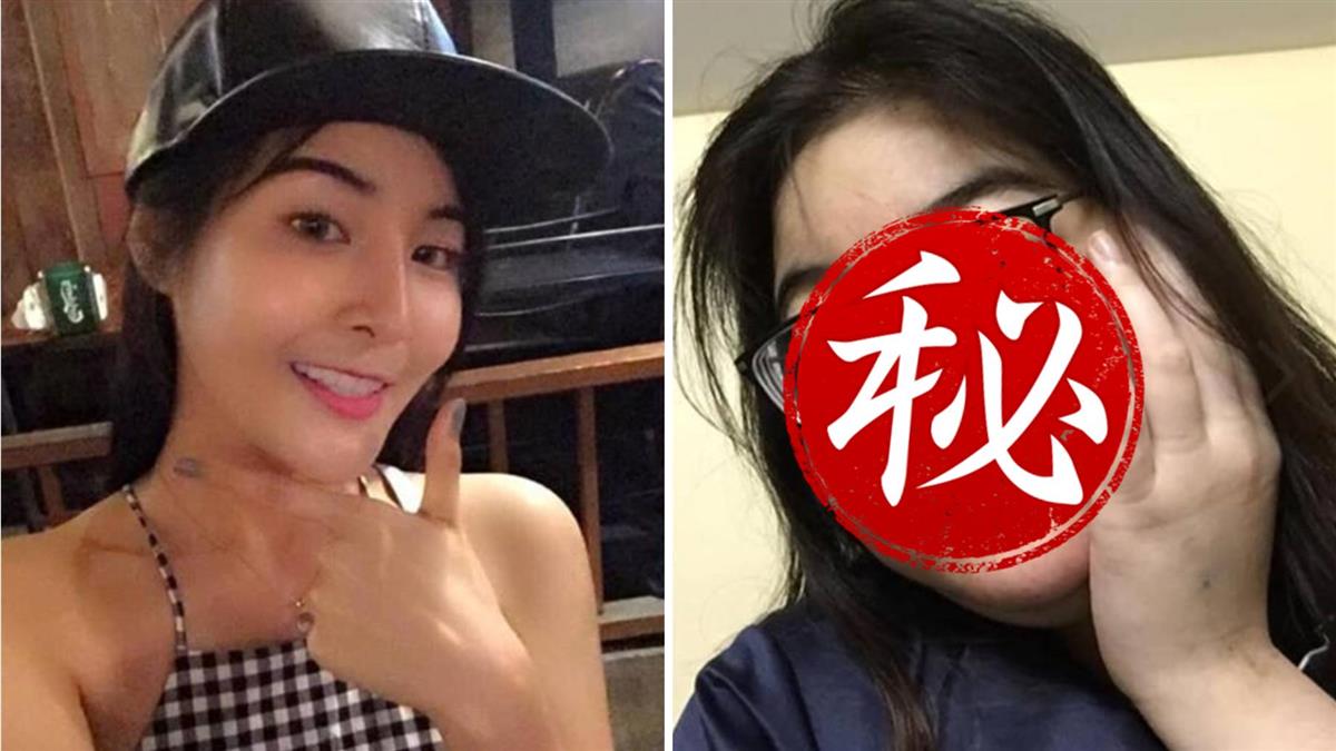 正妹罹怪病暴肥 臉腫2倍!對比照驚呆