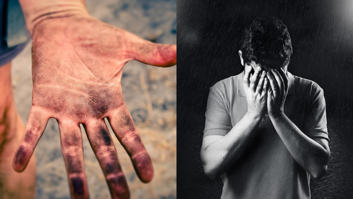 男手掌發黑3個月 醫驚見8cm腫瘤…是胃癌