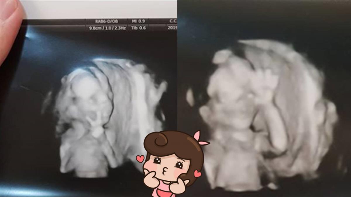4月大兒超音波照神比YA！爸笑翻曝：胎夢2次