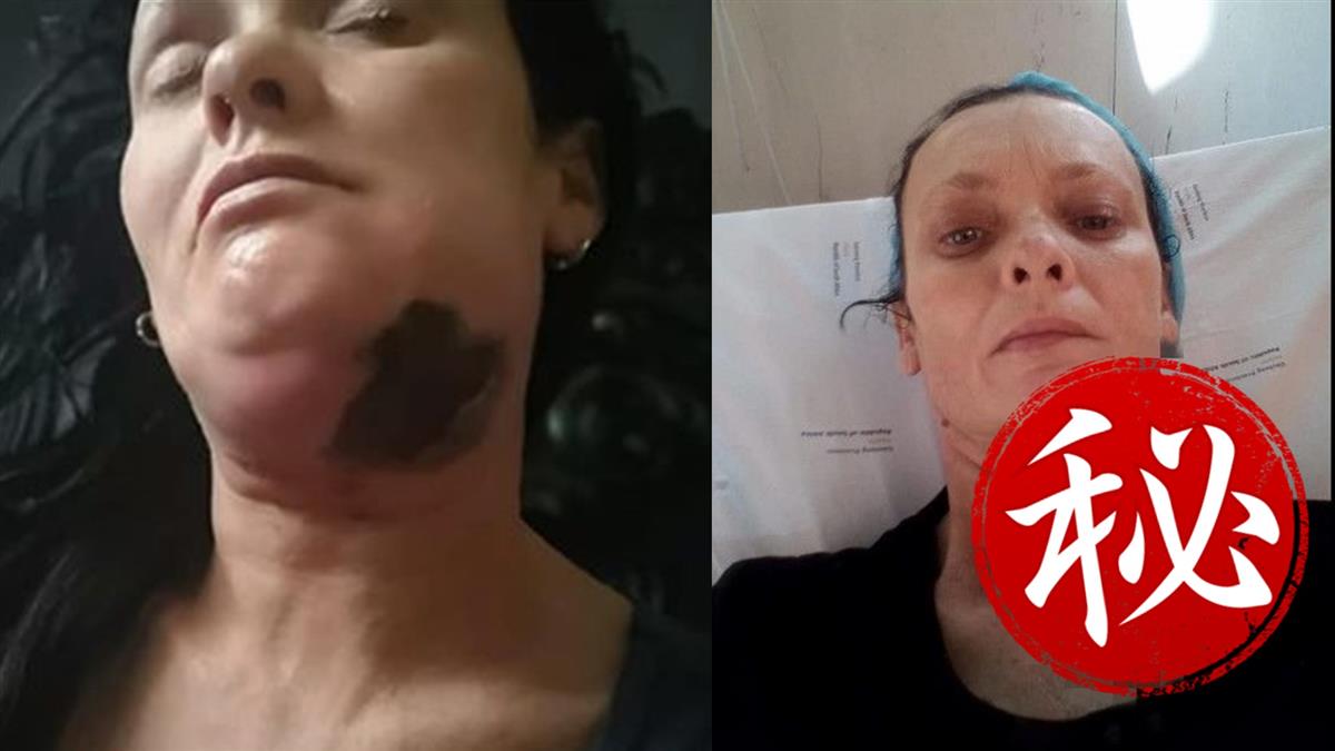 牙痛以為蛀牙!她下巴長3顆黑點…慘變生火腿