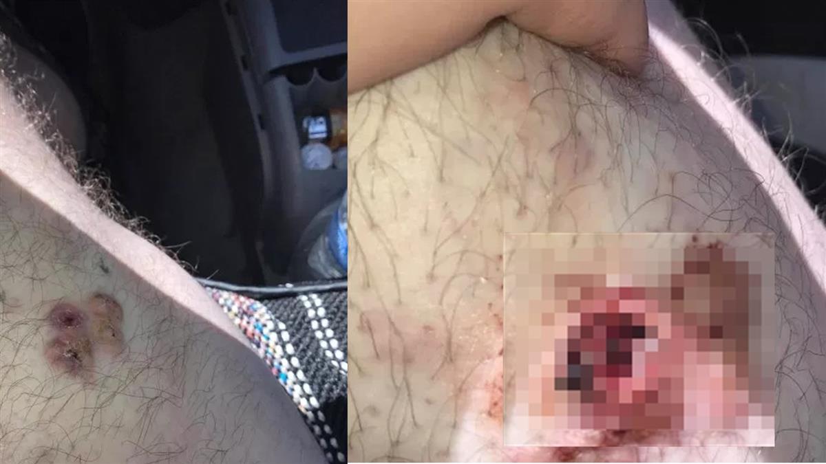 21歲男大腿長「死神的記號」!結果真的要沒命了