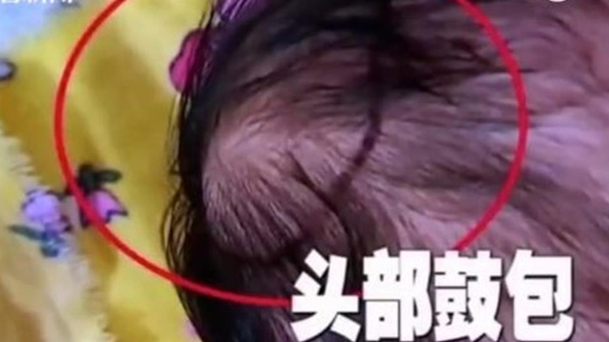 月嫂太累打嗑睡！嬰出生2天 重摔顱內出血