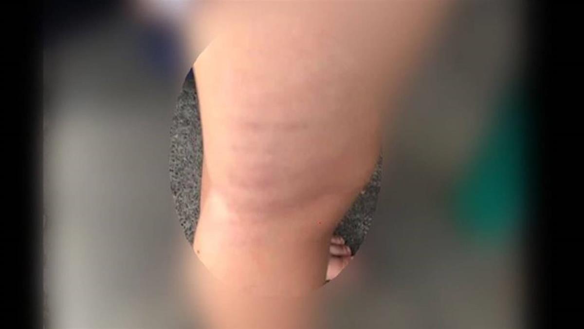 虐童?2歲童身上多處瘀傷 保母:臨托小孩打的