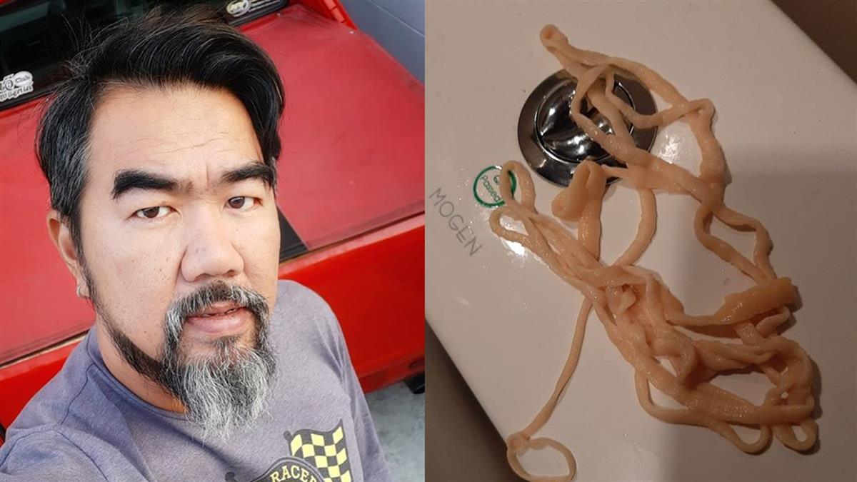 嚇壞！44歲男上廁所 竟拉出10公尺寄生蟲