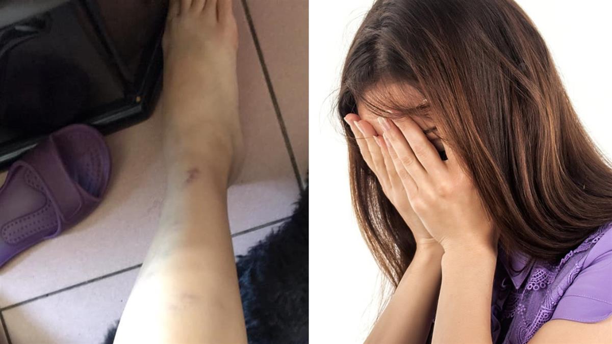 腳突瘀青!27歲妹罹慢性腎衰竭 淚崩:從沒想過…
