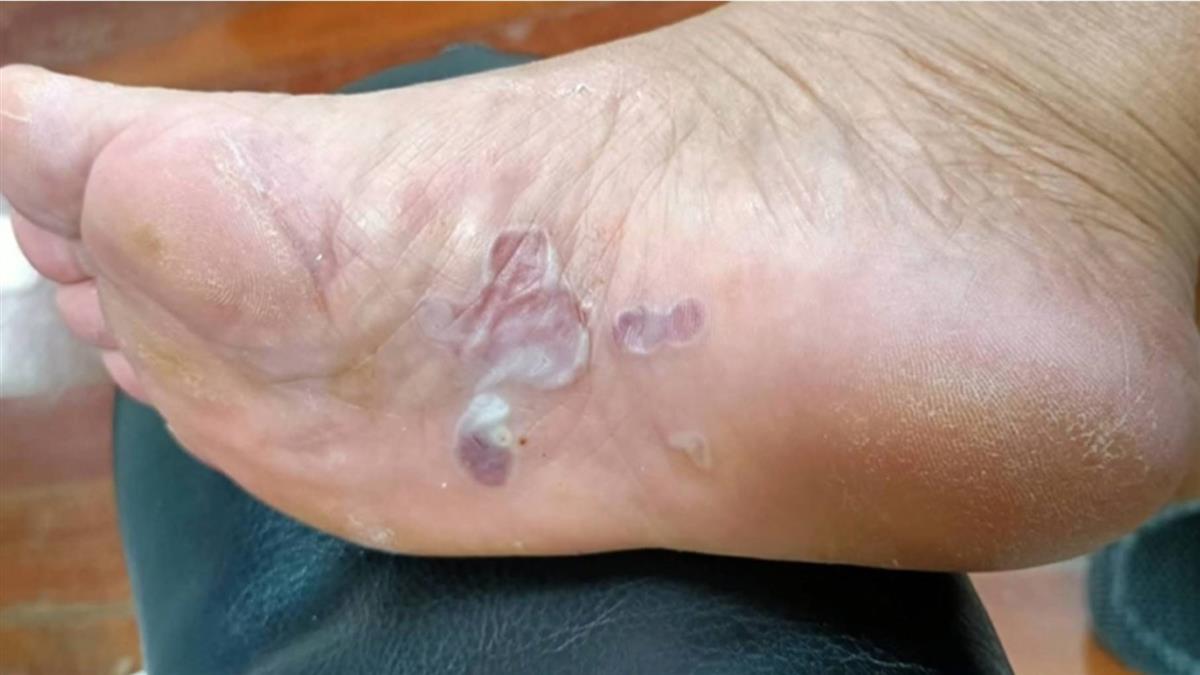 暖暖包貼腳底穿襪睡 7旬婦雙腳起3公分大水泡