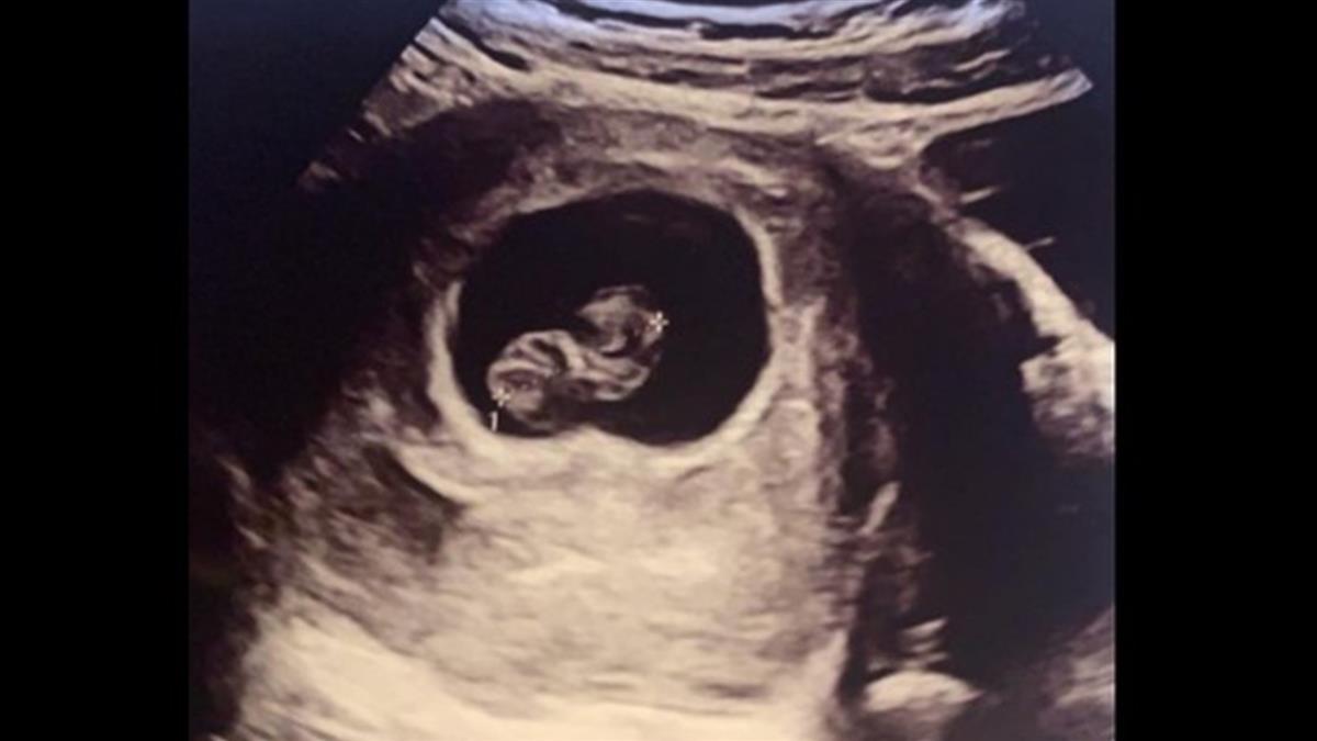 8週寶寶死腹中！人妻沿街乾嘔 痛訴：老公只顧滑手機