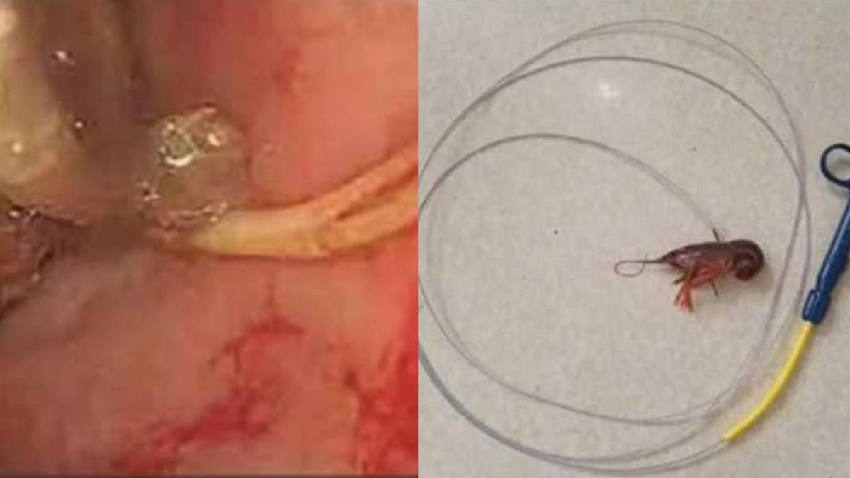 悚!男童屁股釣出小龍蝦急送醫 自曝「想把牠變蝦乾」