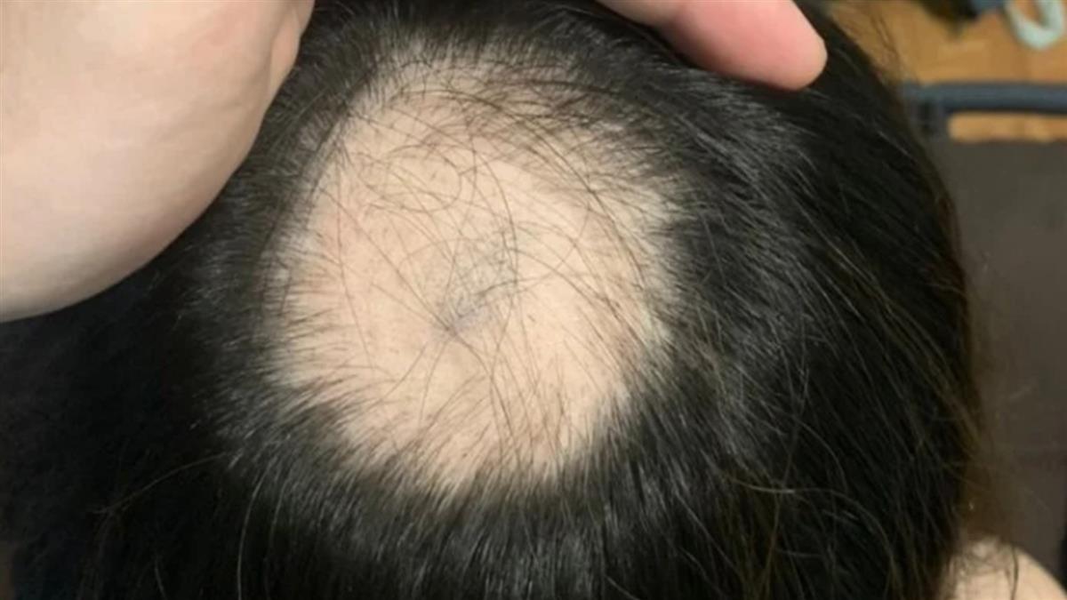 台大打莫德納！24歲女慘變禿頭 側邊也掉光