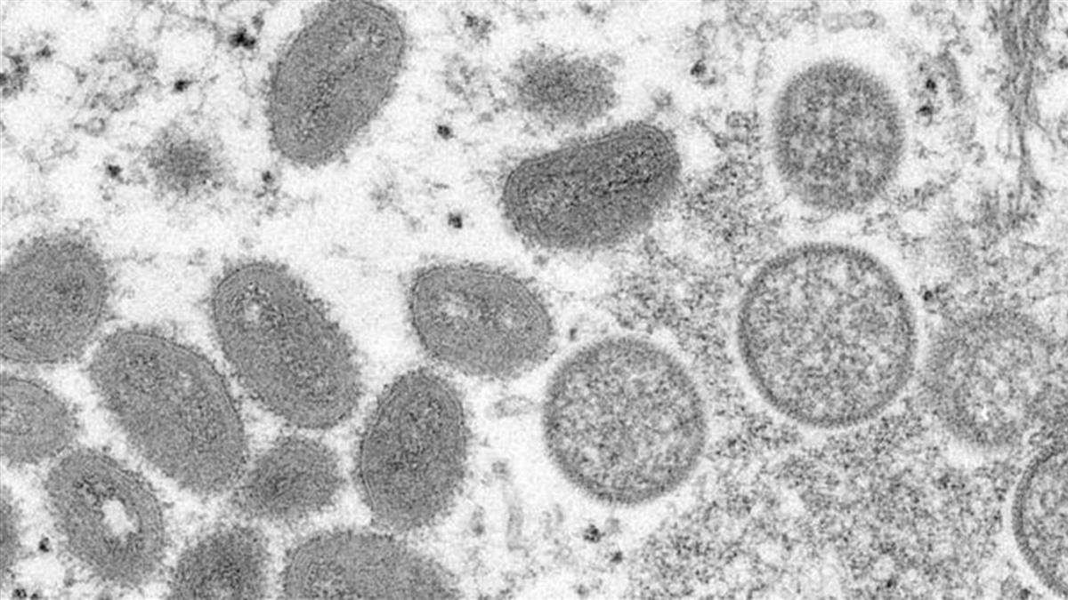 新加坡出現首個本土猴痘病例 患者症狀出爐