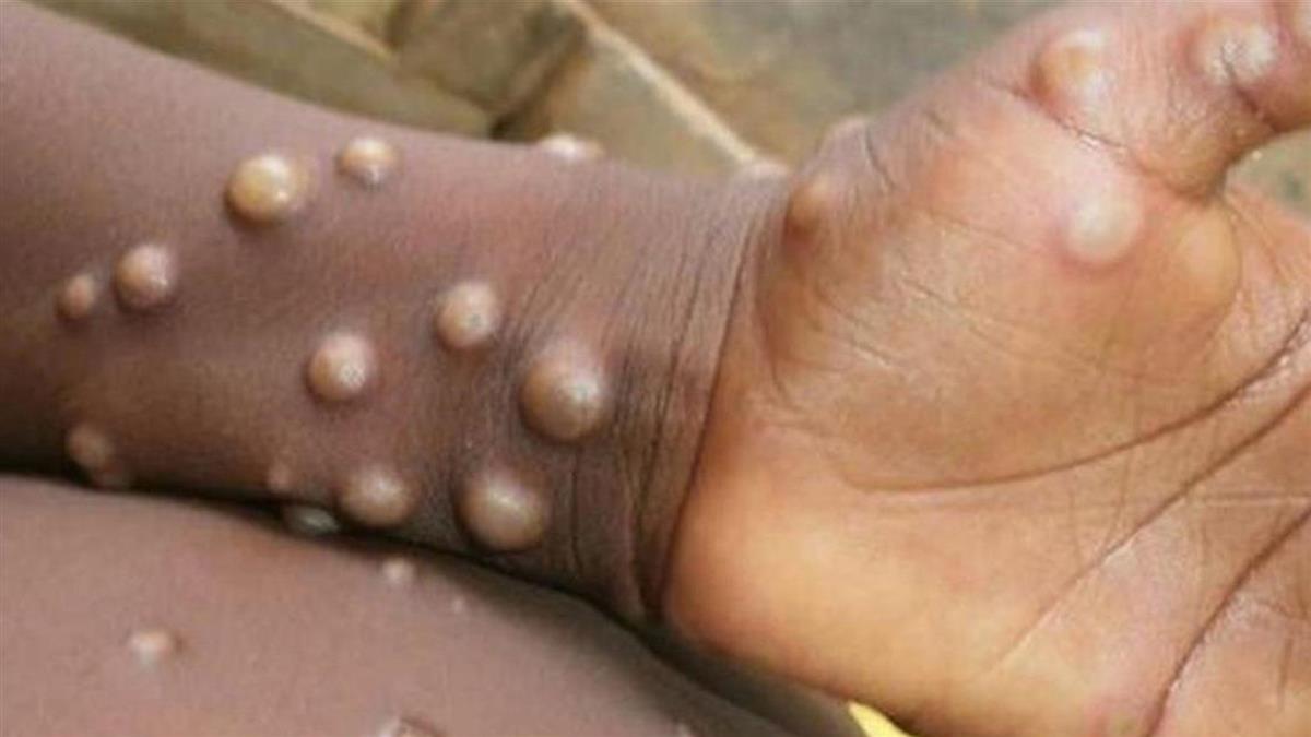 首例猴痘入境！基因定序出爐 和歐美流行相同