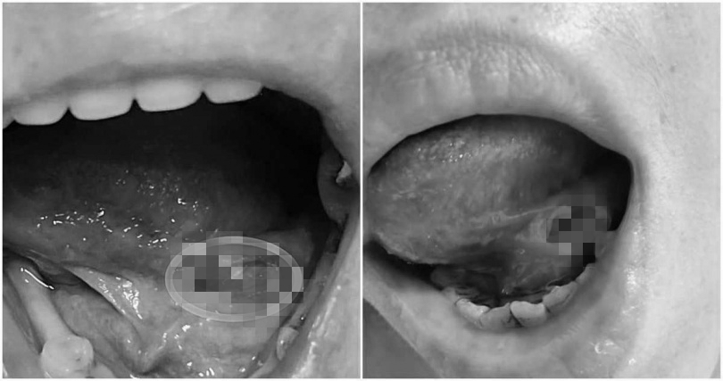 ▼原PO嘴巴破洞傷口超深。（圖／翻攝自爆料公社臉書）
