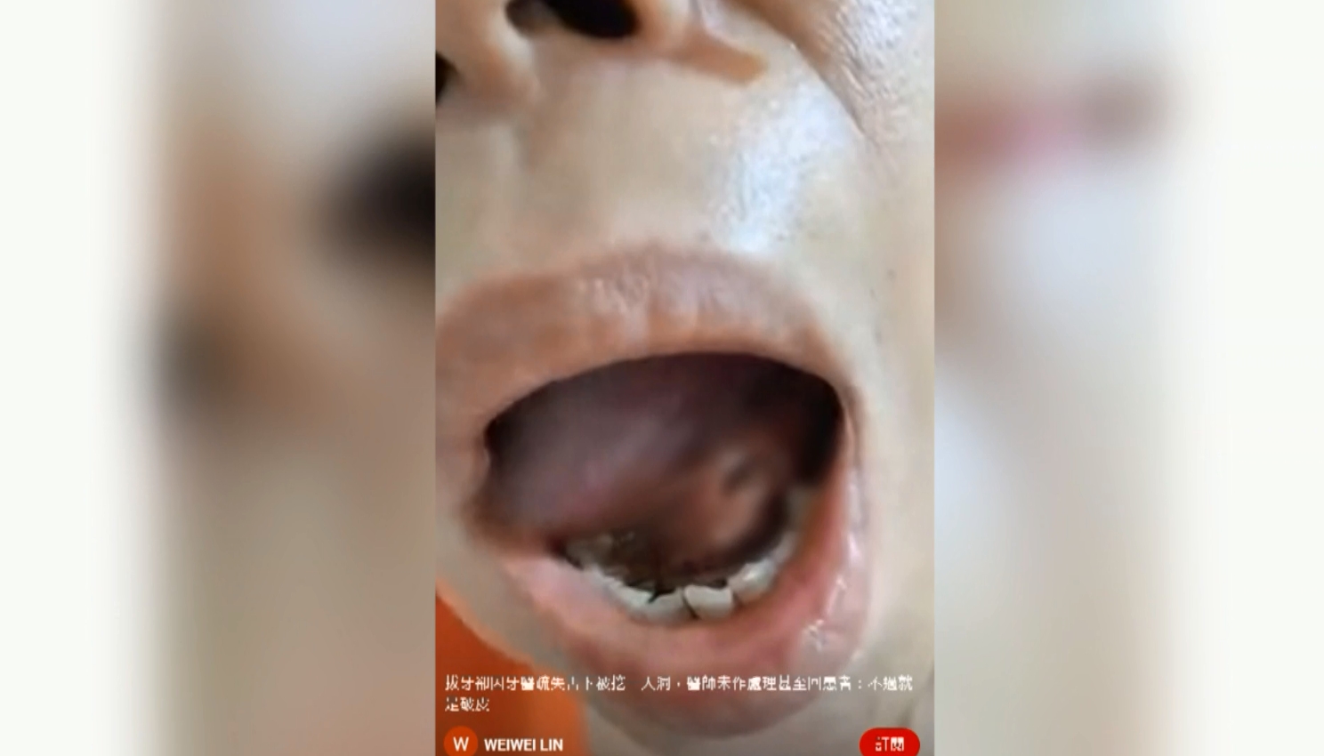 ▼民眾回家後才發現自己嘴巴內的大傷口。（圖／東森新聞）