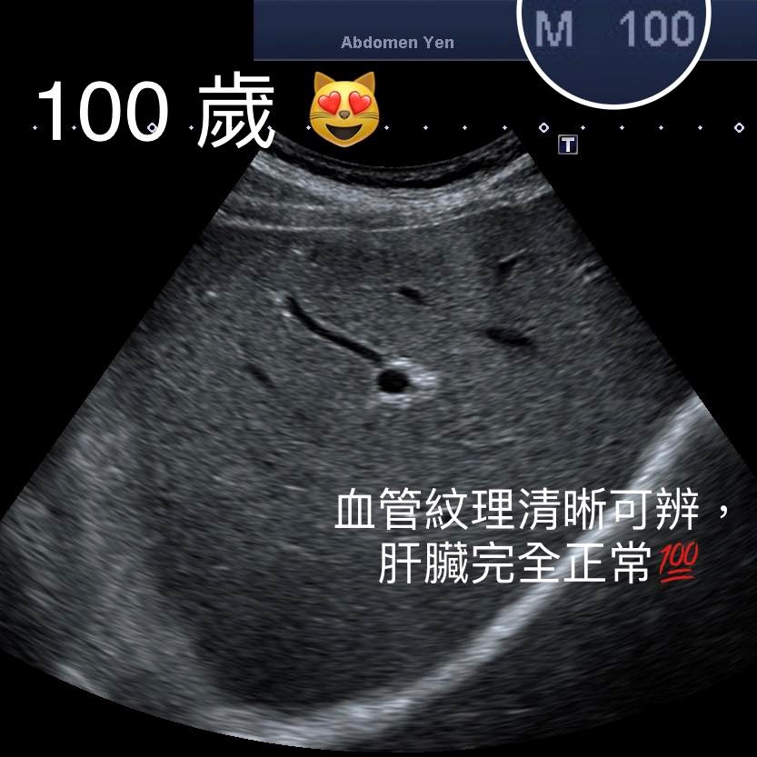 ▼▲100歲的肝臟比28歲年輕人還健康。(圖/錢政弘醫師提供)