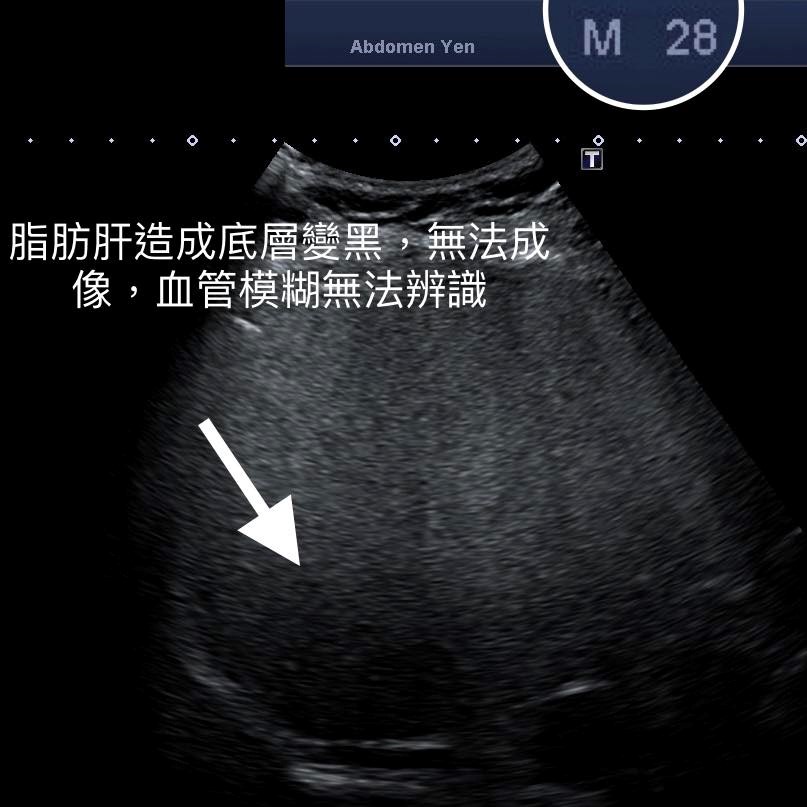 ▼▲100歲的肝臟比28歲年輕人還健康。(圖/錢政弘醫師提供)