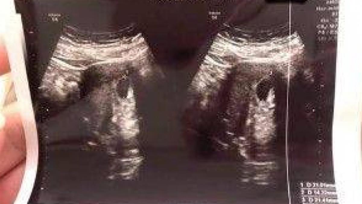 他自曝「最後滾床日」求醫看胎兒幾周 網驚：綠綠的