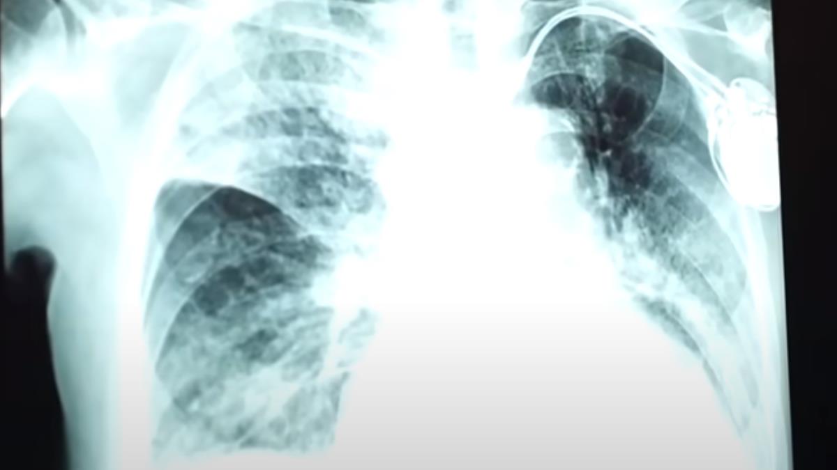 聚焦真相／新冠捲土重來 恐春節前夕大爆發