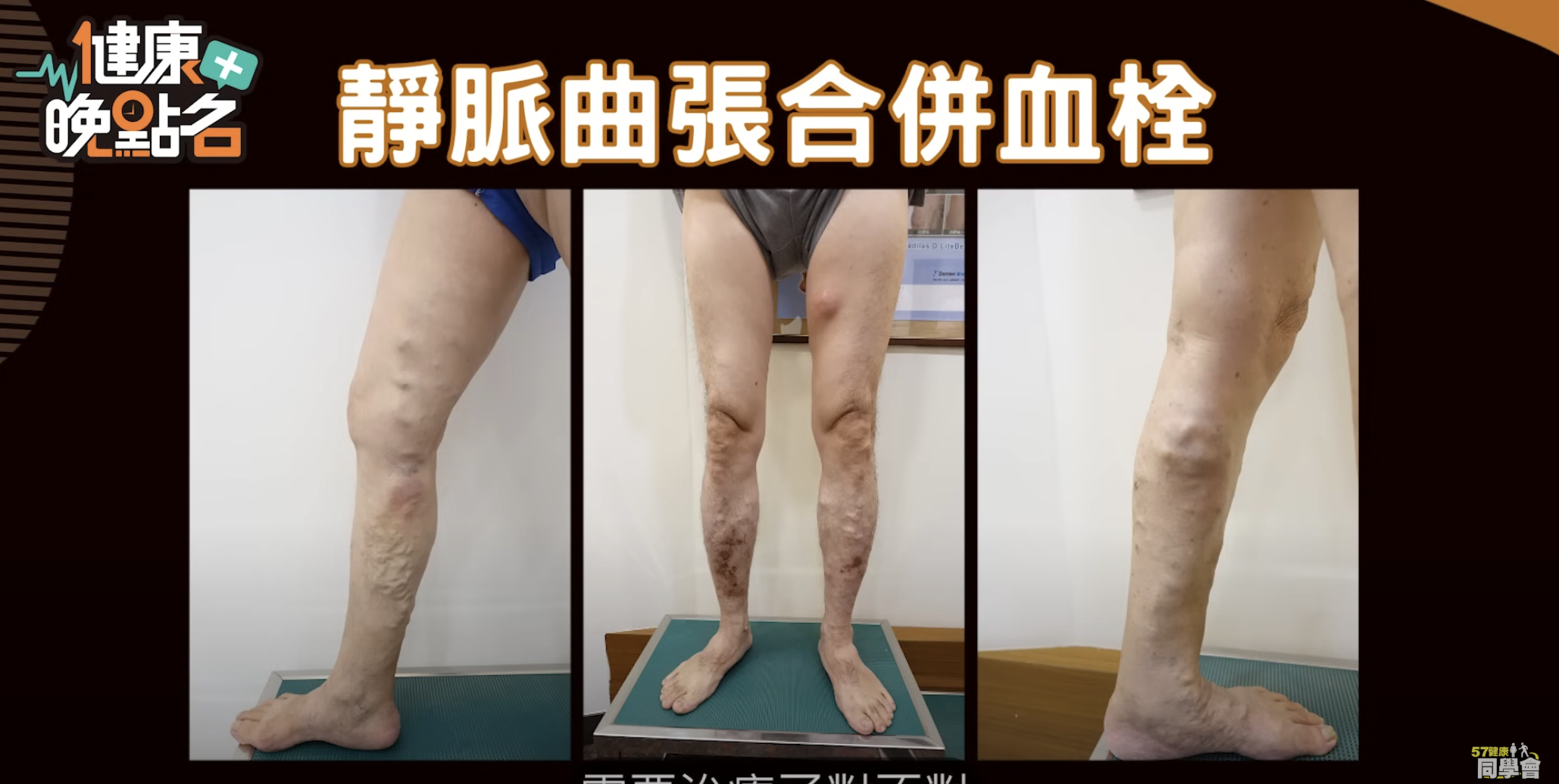 醫師示警靜脈曲張合併血栓危及健康。東森新聞