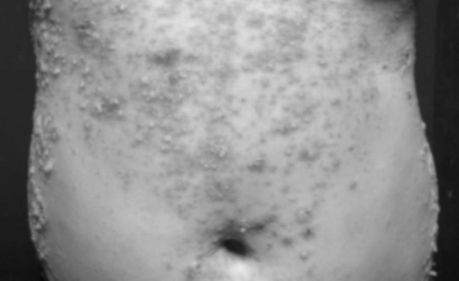 GPP患者發病照片_腹部