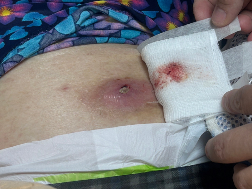 1-傷口未清創前狀況_0