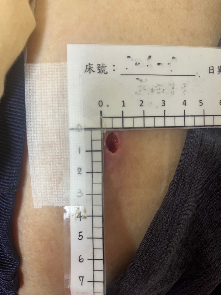 5-每日傷口追蹤與紀錄_0