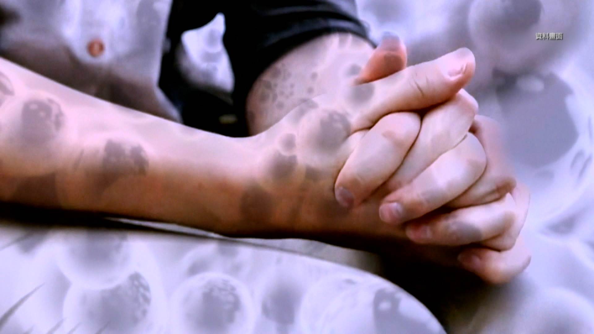 誘發帶狀疱疹，對三高患者的生活更是造成極大衝擊，應小心防範。（圖／東森新聞）