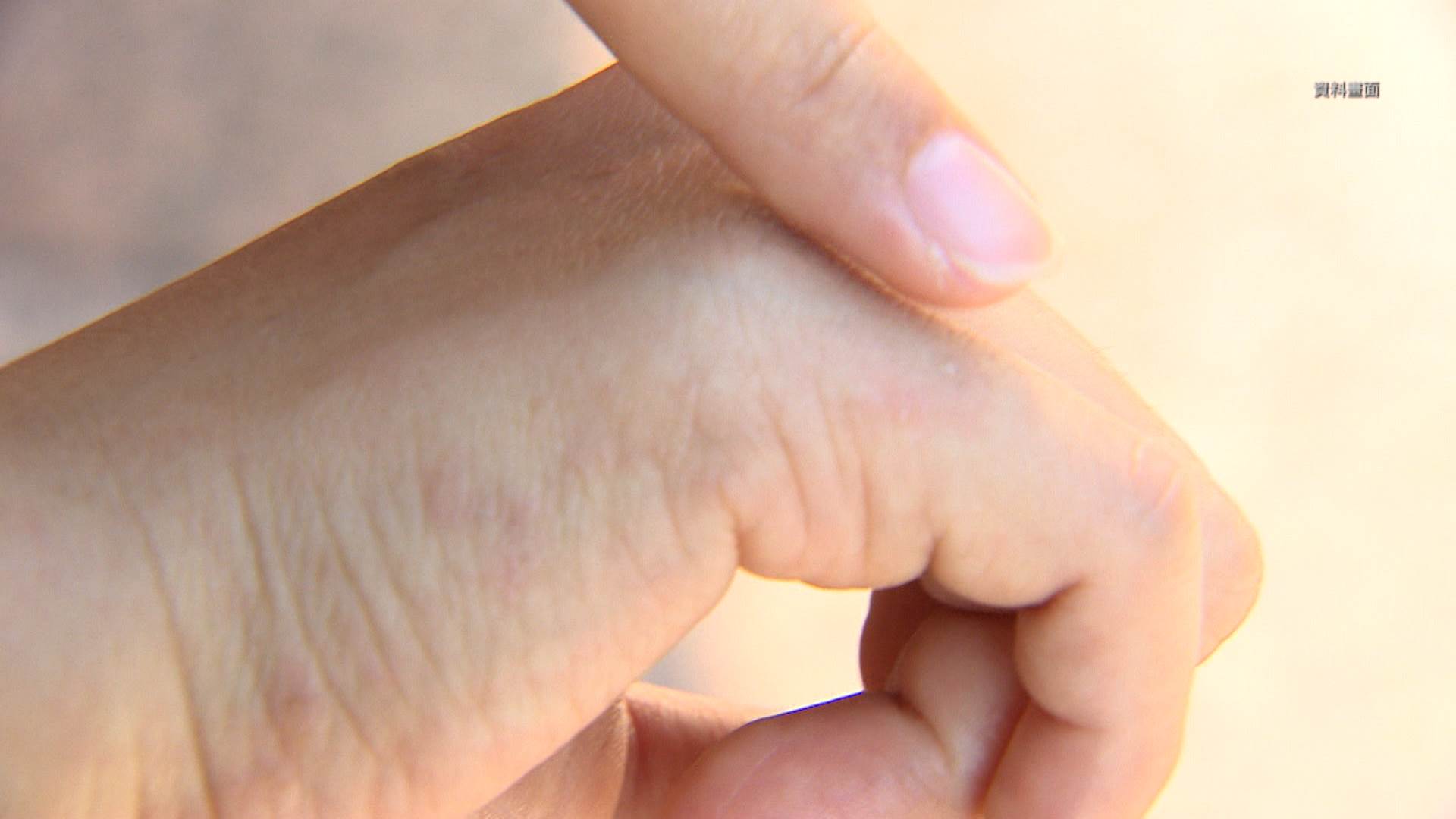 皮蛇纏身的風險，除了發病時的搔癢疼痛，疱疹後神經痛，也可能與心血管或，腦血管事件的風險上升有關。（圖／東森新聞）