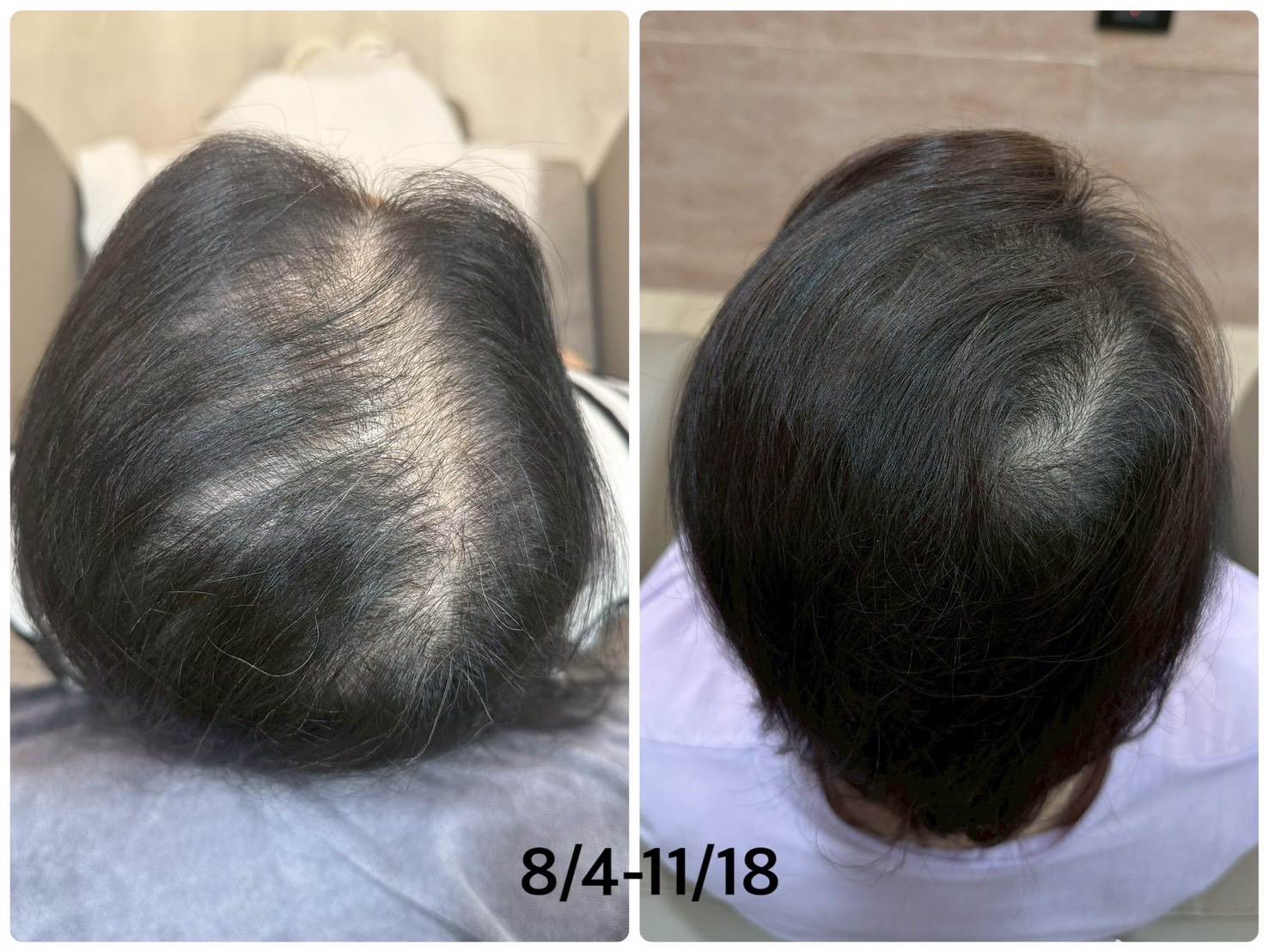 「不用植髮」的新選擇，BeautyAgent 以外囊泡科技改寫生髮邏輯。