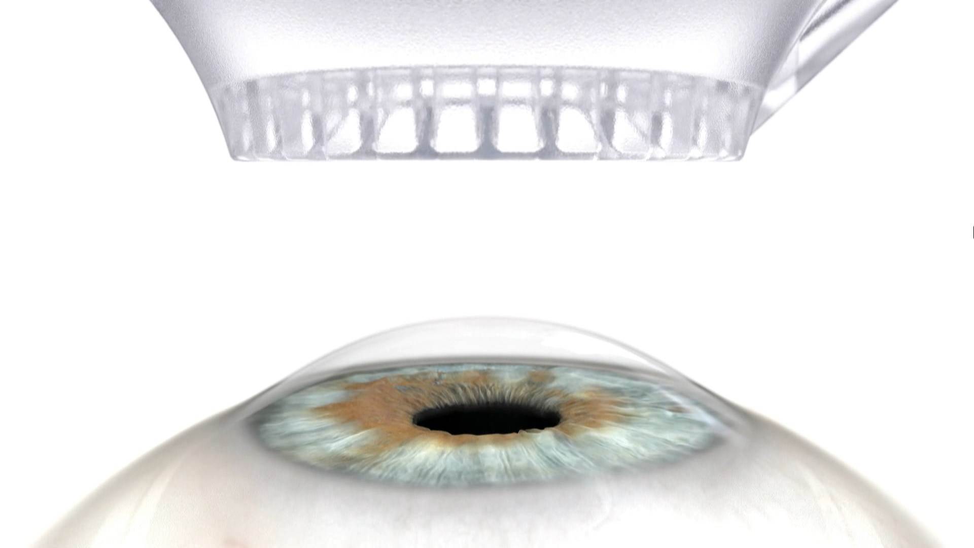 醫師可依據個人角膜厚薄、瞳孔大小及度數狀況，調整治療參數，進一步優化術後結果。（圖／東森新聞）