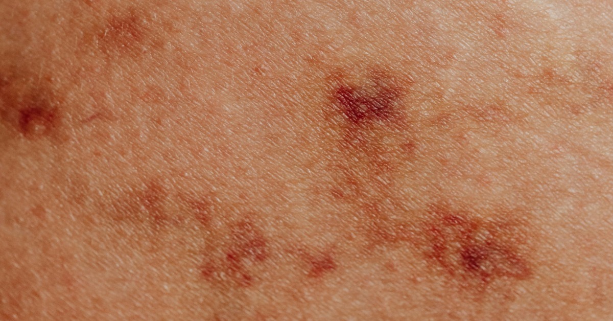 新北麻疹本土病例! 526人遭匡列 衛生局回應了