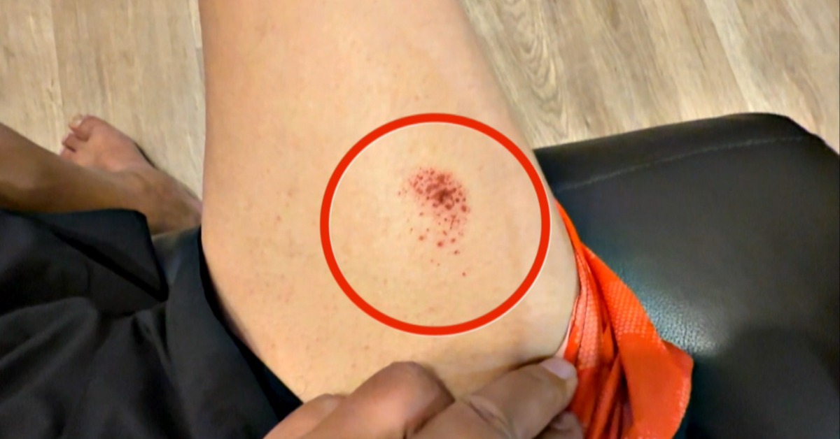 獨家/碳鋅電池「放口袋」突發熱! 大腿慘遭「灼傷」