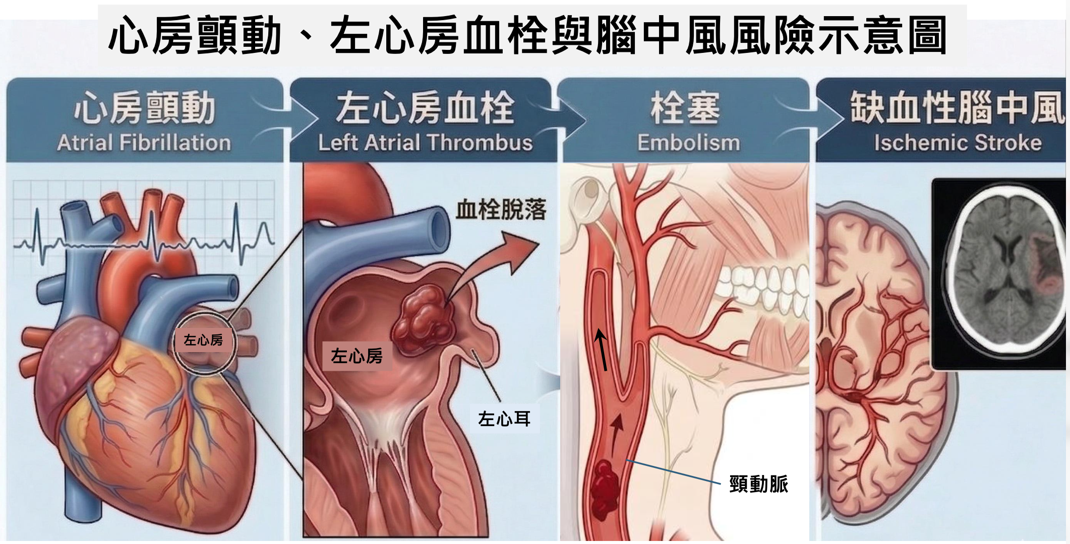 心房顫動與腦中風風險示意圖