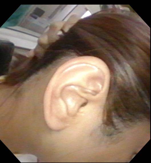 右側耳後切口的<a href='/search/tags/達文西/' target='_blank'>達文西</a>腮腺手術，讓傷口僅2.5公分藏在耳後.JPG