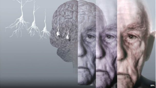 驚!研究:器官移植 恐染阿茲海默症