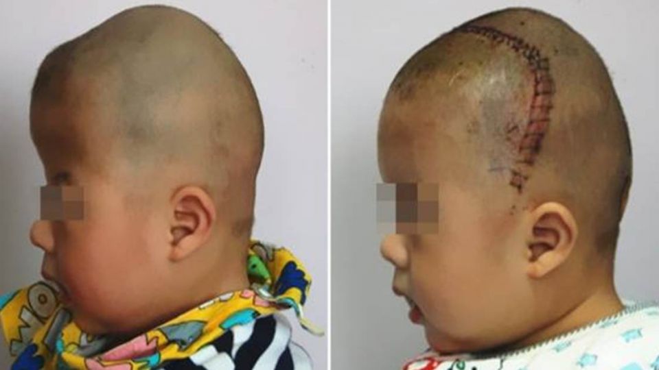 男嬰頭骨畸形像ET 「3D列印」讓他重獲新生