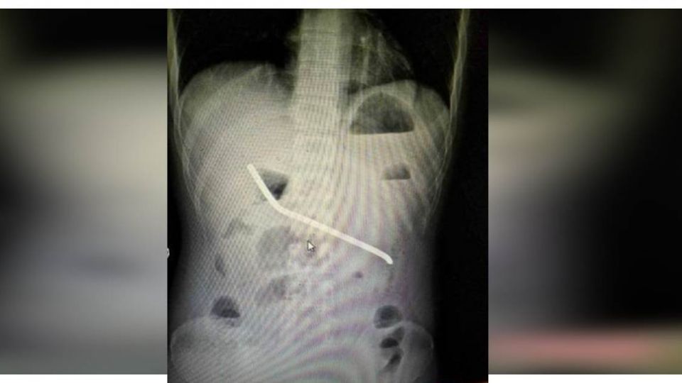 怎麼進去的?男子腹部腫脹 X光片竟照出一條長長鋼條