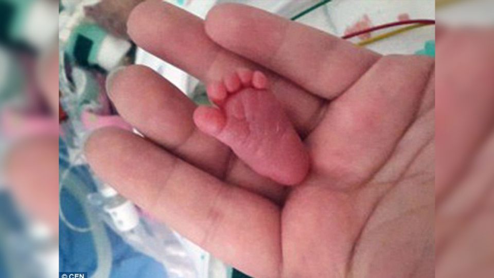 ​3公分腳掌娃娃！出生僅226克 全球最小女嬰奇蹟般活下來