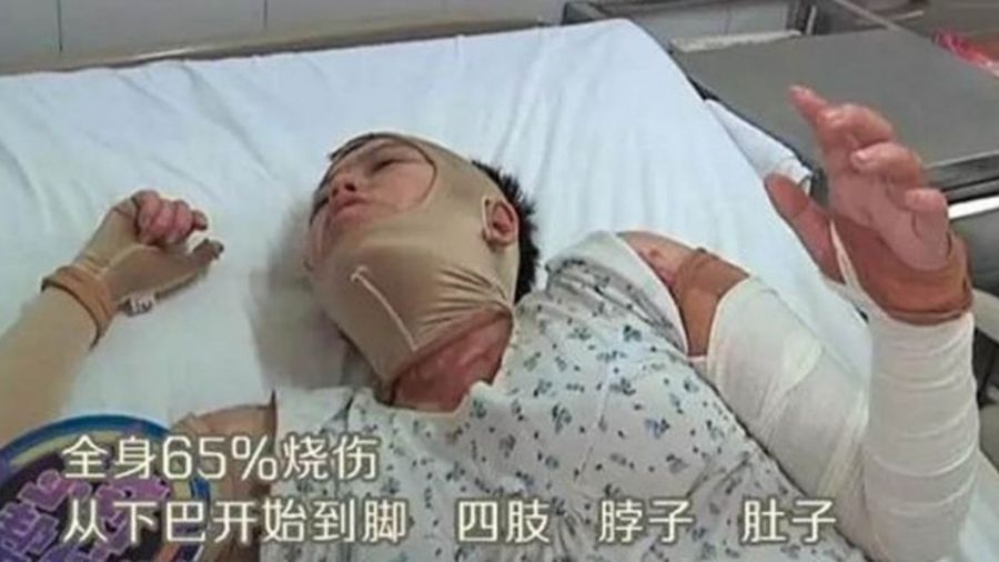 孕媽媽遭火紋身 為寶寶「不上麻藥」讓醫生扒皮清創