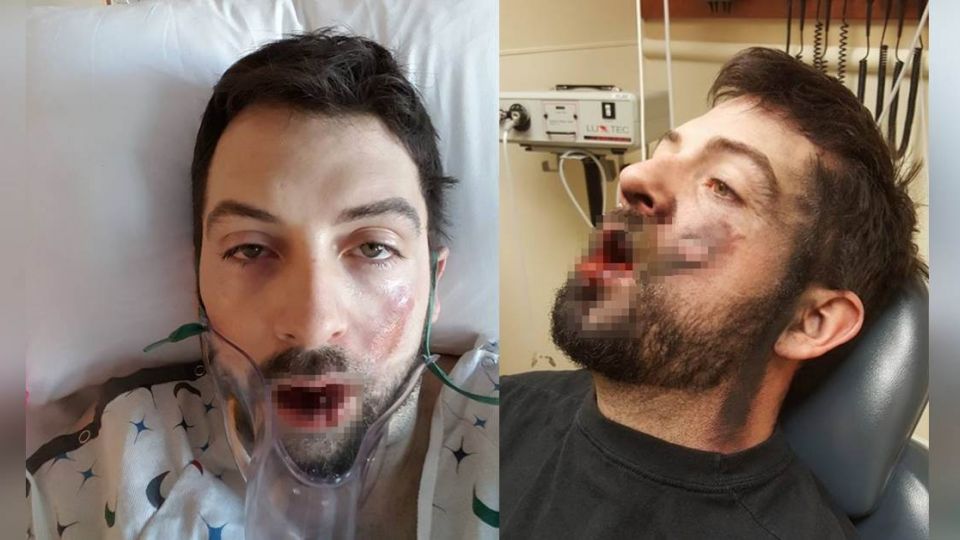 驚悚!電子菸「口中爆炸」 壯男滿嘴碎片痛失7牙