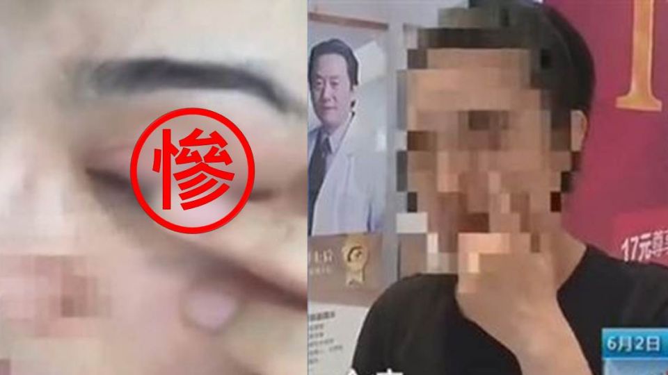 完了!她割雙眼皮慘「破洞」 漏眼淚還見眼球咕溜轉