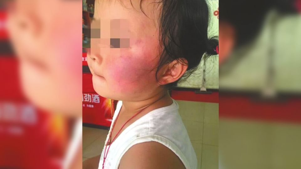 打到雙頰紅腫！學童吵鬧講不聽 老師竟要他們「互搧耳光」