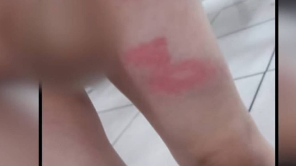 【獨家影片】三歲男童兩腿紅腫瘀血 家長老師互控毆打