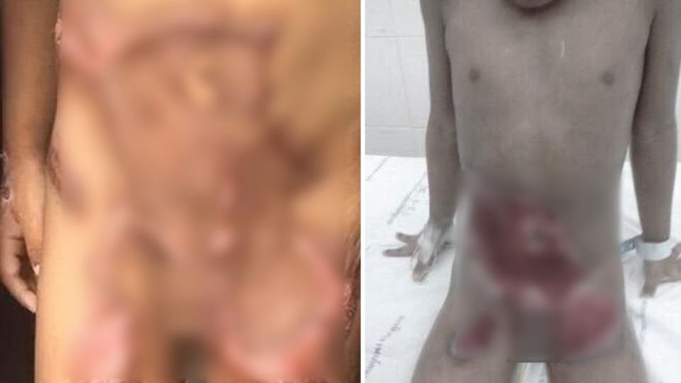 狠!保母丈夫潑熱水燙下體 5歲童忍淚「去勢保命」