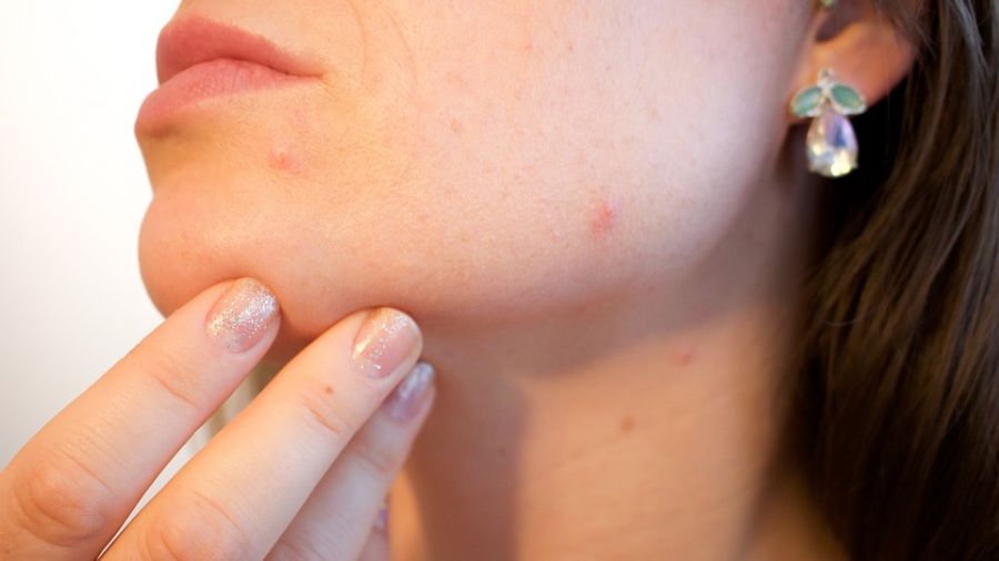 小心留疤!手癢愛「擠痘痘」要注意 醫:這3種擠不得