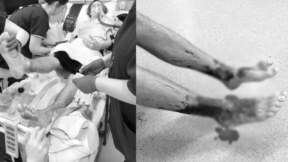 【更新】悚！少年雙腳泡海水放鬆 30分鐘後…竟布滿小孔「鮮血淋漓」