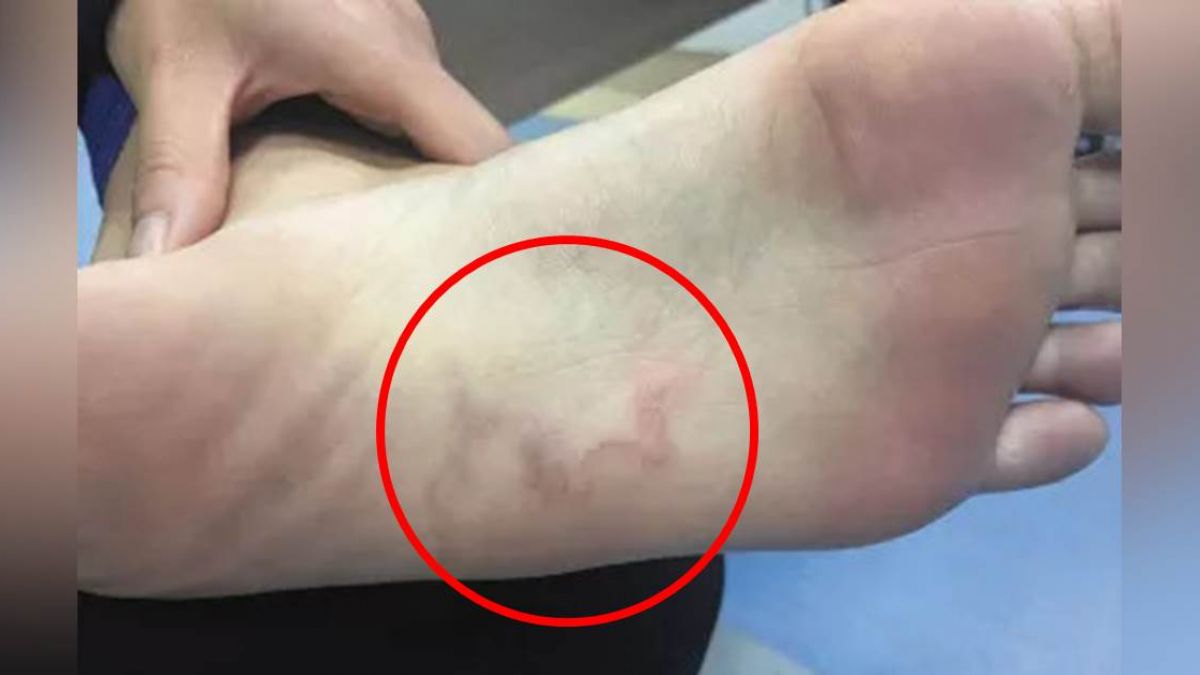 新娘赤腳走沙灘 遭寄生蟲鑽入!腳底啃出一條隧道…