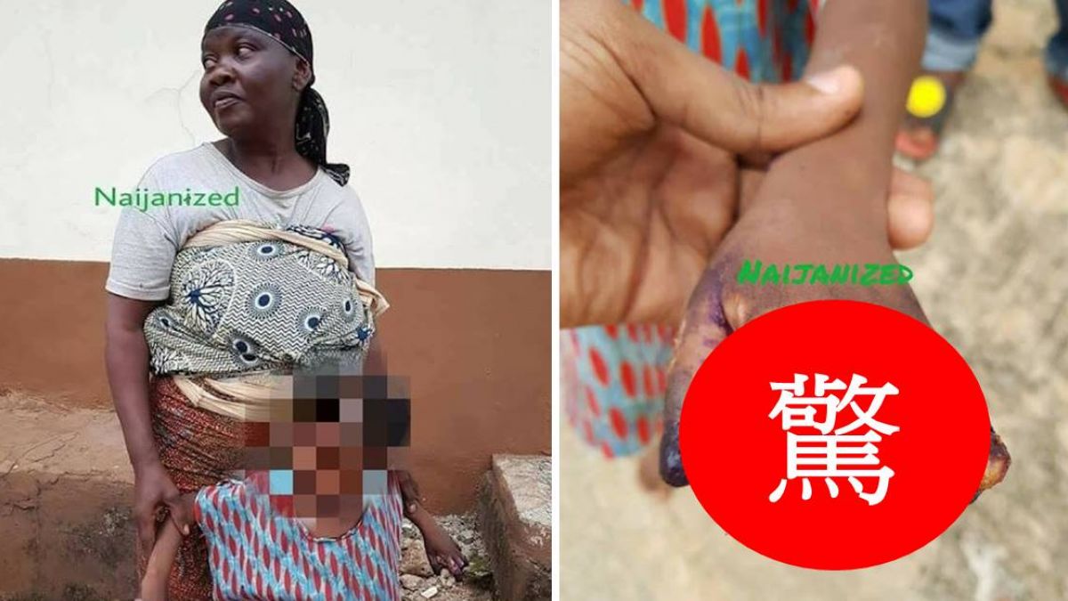 殘忍！孫女偷吃麵 惡嬤抓手放瓦斯爐上烤…整節手指慘融化