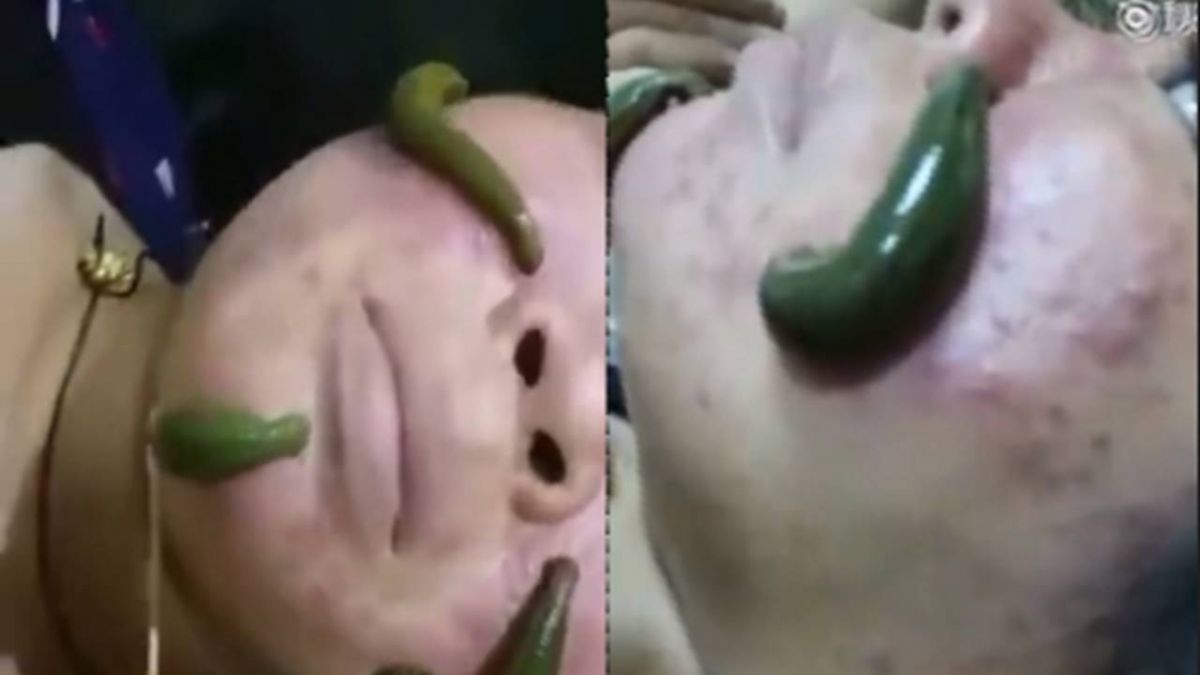 蠕動水蛭清痘痘! 美容師:千年療法還可撫平皺紋